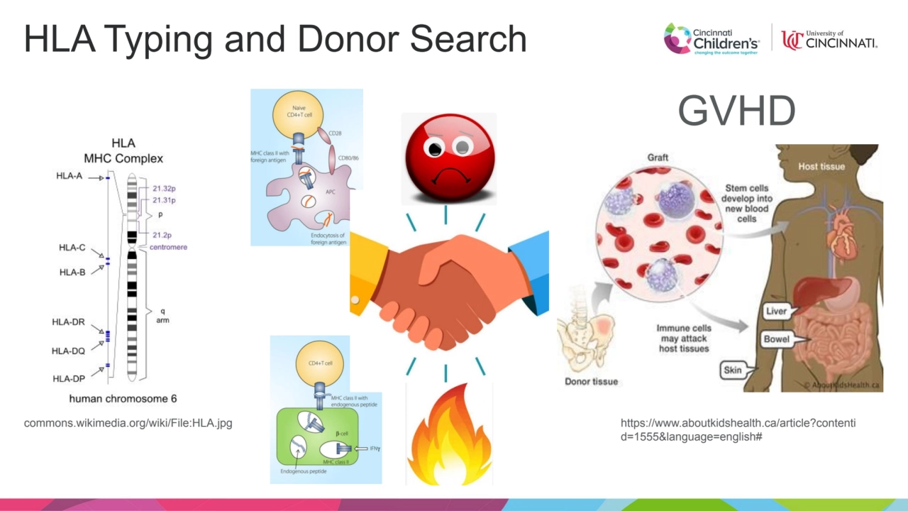 HLA Typing and Donor Search
commons.wikimedia.org/wiki/File:HLA.jpg https://www.aboutkidshealth.ca…