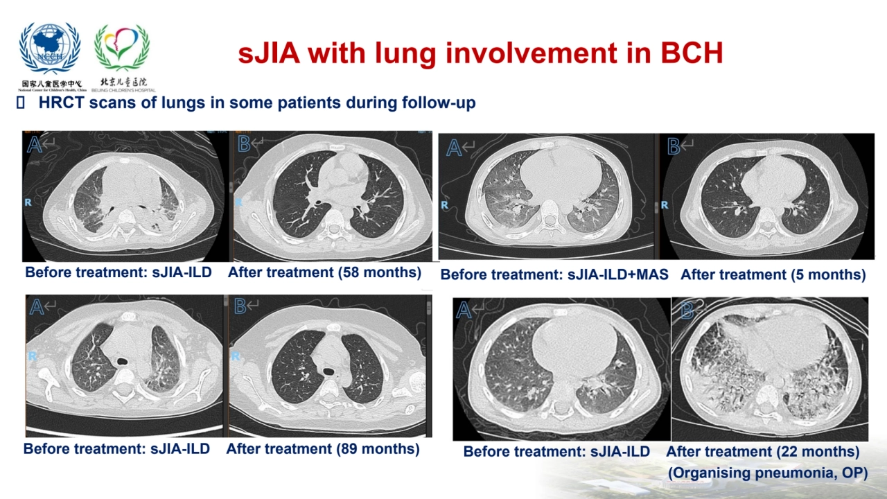 sJIA with lung involvement in BCH
 HRCT scans of lungs in some patients during follow-up 
Before …