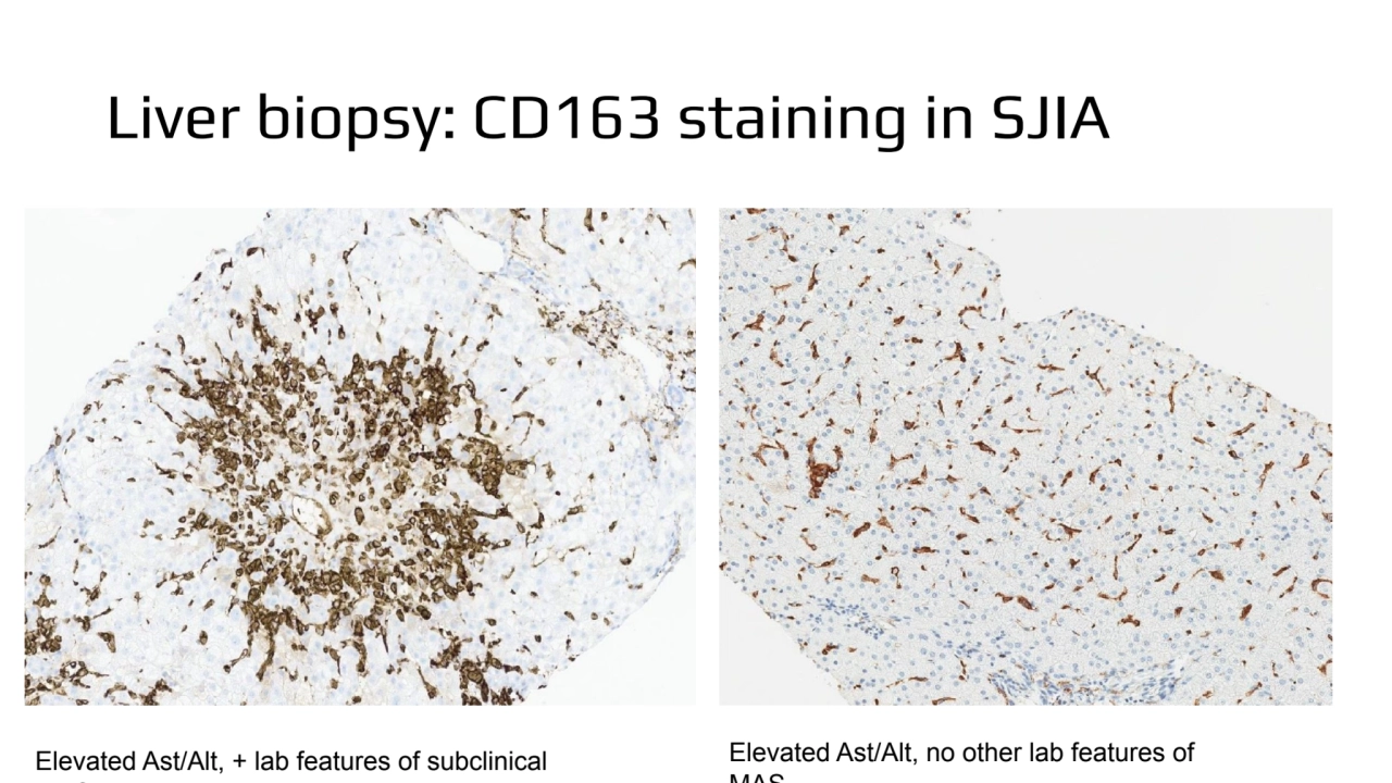 Liver biopsy: CD163 staining in SJIA
Elevated Ast/Alt, + lab features of subclinical 
MAS
Elevat…