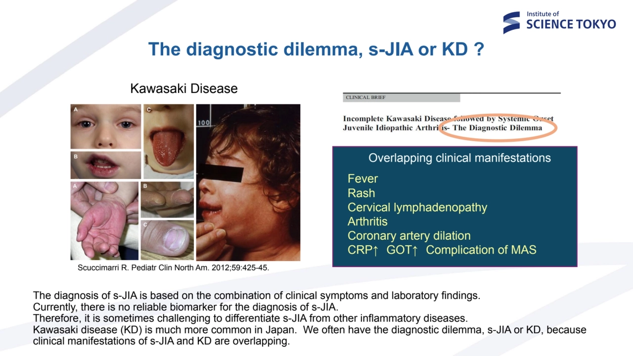 Fever
Rash
Cervical lymphadenopathy
Arthritis
Coronary artery dilation
CRP↑ GOT↑ Complication …