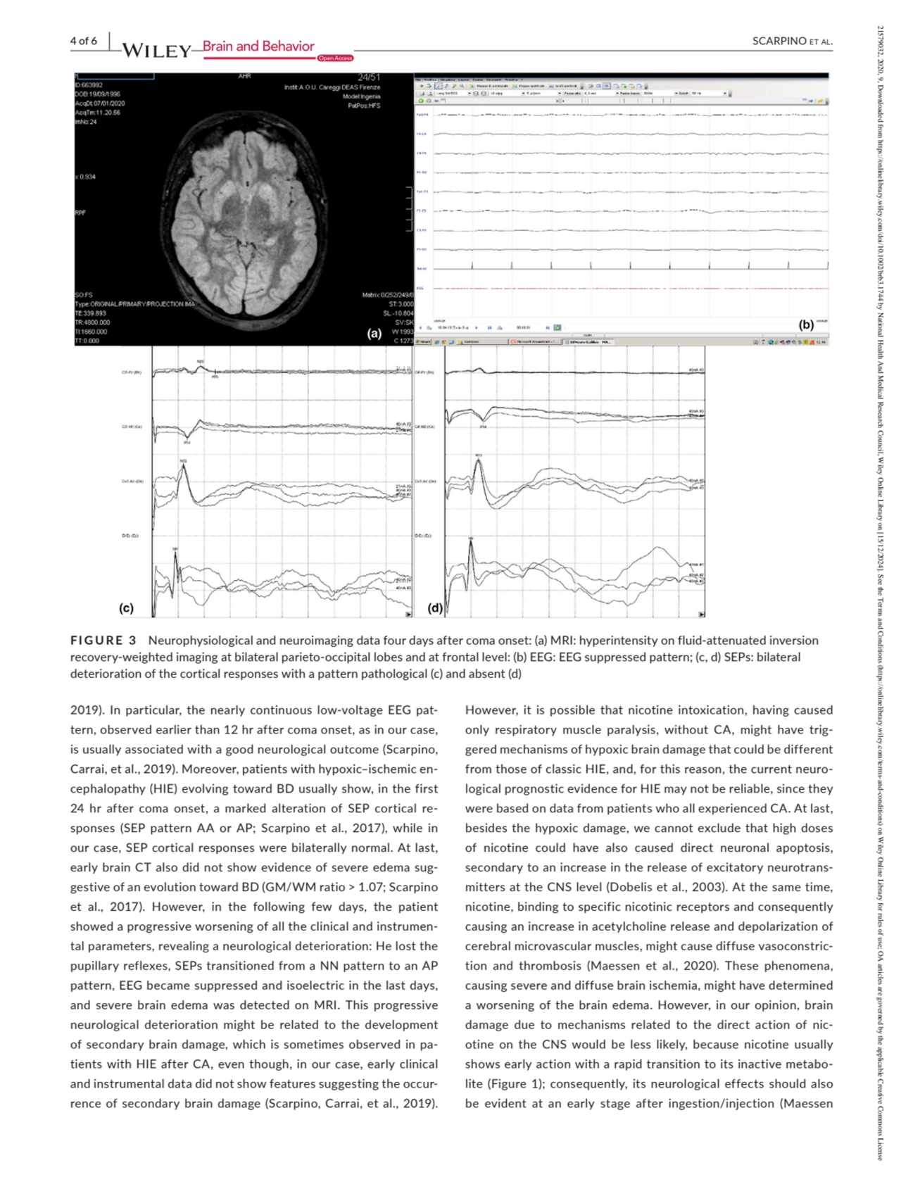 4 of 6  |     SCARPINO et al.
2019). In particular, the nearly continuous low-voltage EEG pattern…