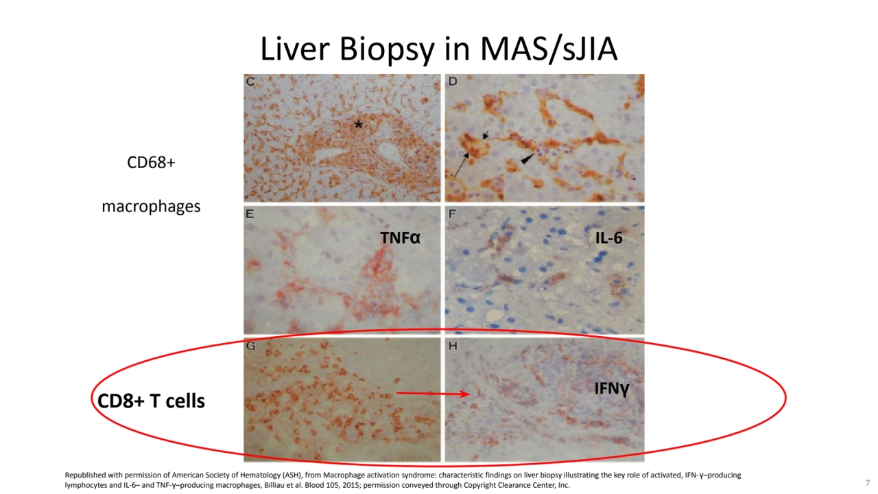 CD68+
macrophages
Liver Biopsy in MAS/sJIA
CD8+ T cells
TNFα IL-6
IFNγ
Republished with permi…