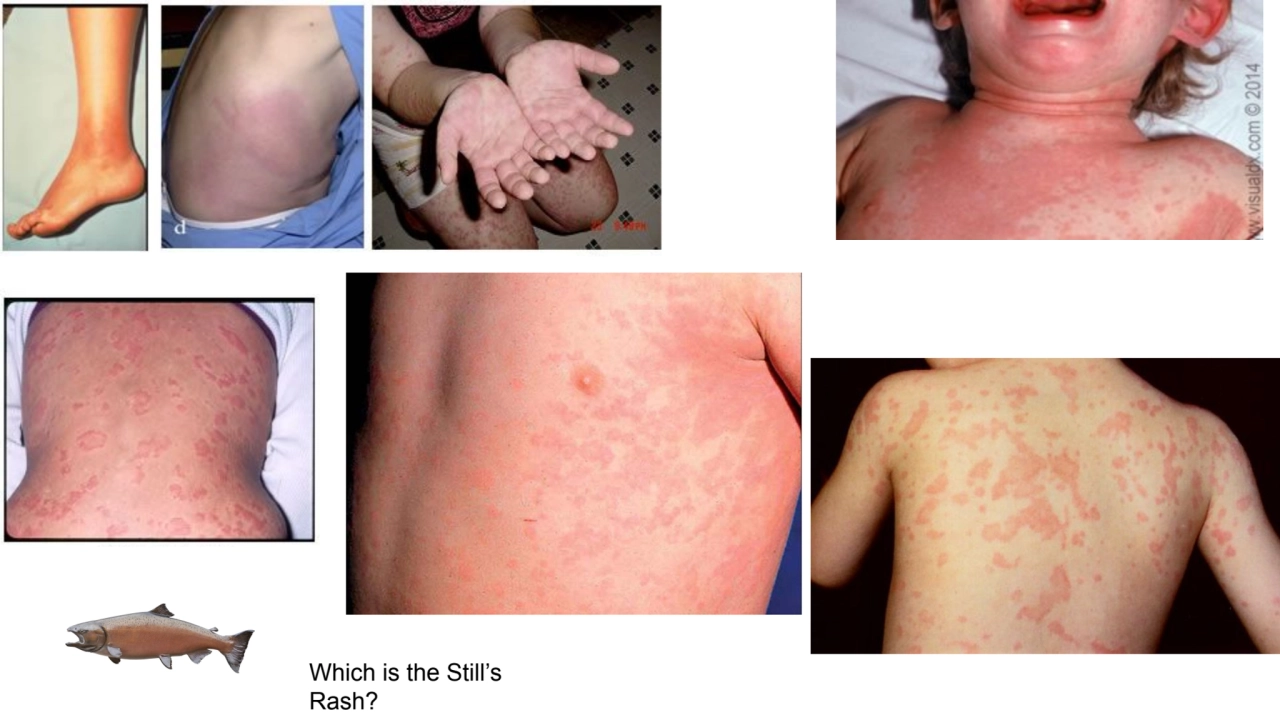 Which is the Still’s 
Rash? 