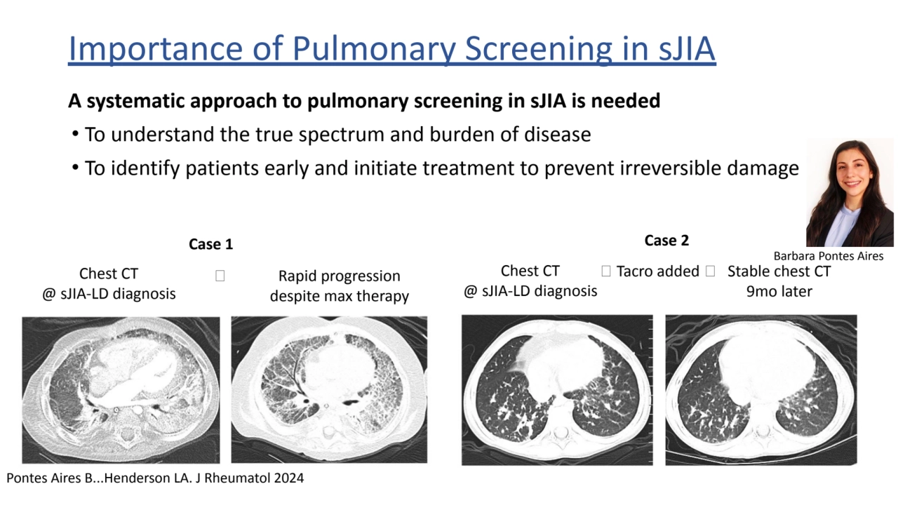 Importance of Pulmonary Screening in sJIA
A systematic approach to pulmonary screening in sJIA is …