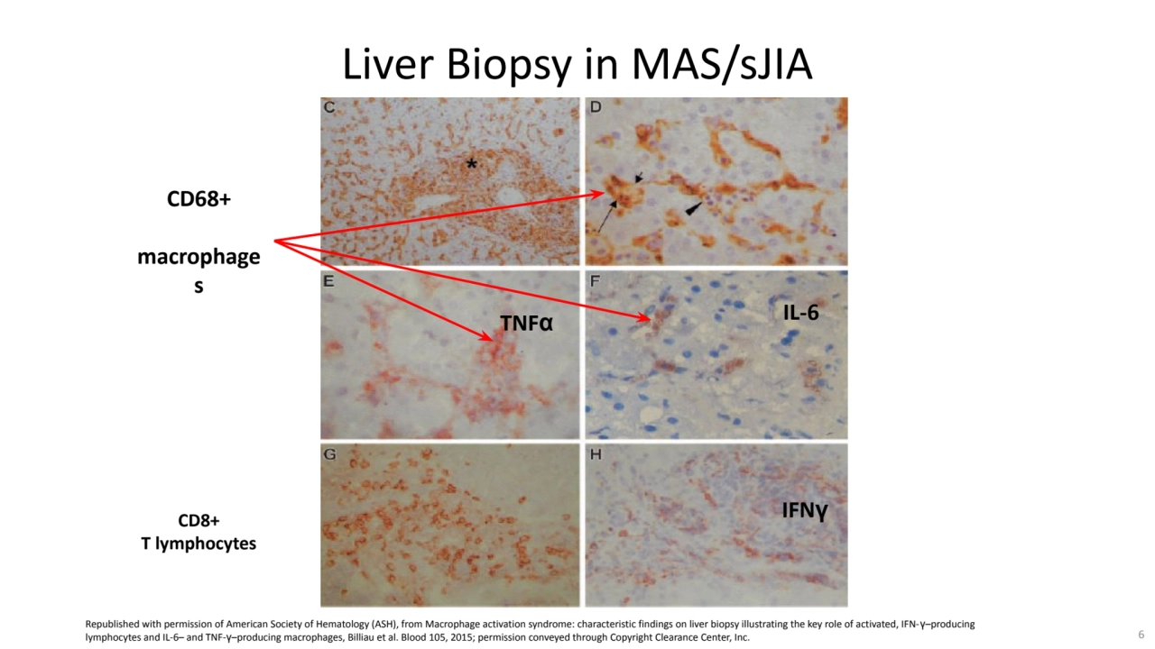 CD68+
macrophage
s
TNFα
IL-6
IFNγ
Liver Biopsy in MAS/sJIA
CD8+ 
T lymphocytes
Republished…