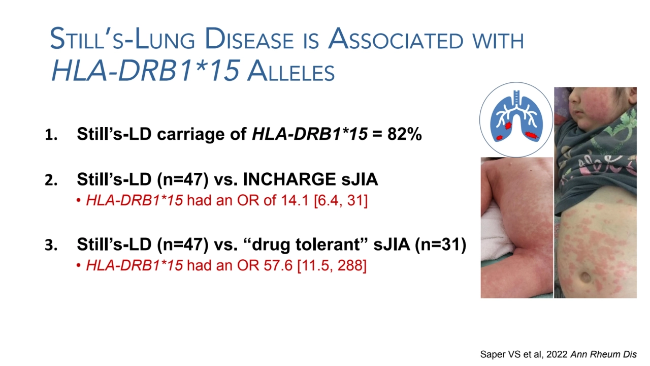 STILL’S-LUNG DISEASE IS ASSOCIATED WITH
HLA-DRB1*15 ALLELES
1. Still’s-LD carriage of HLA-DRB1*15…